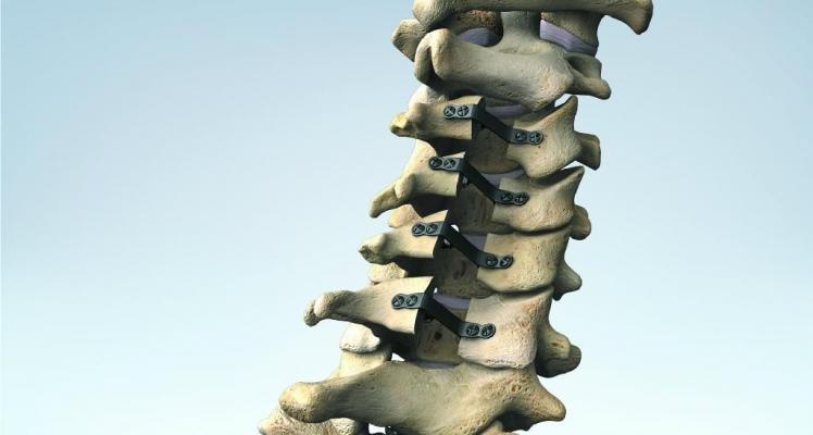 椎板固定板系统