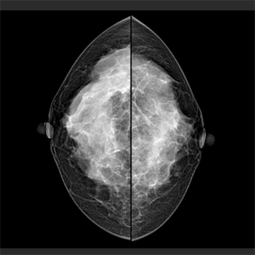 Yizhun MGIPS乳腺X射线影像处理软件