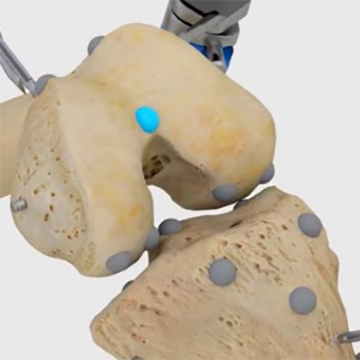 膝关节置换手术导航系统surgical navigation system