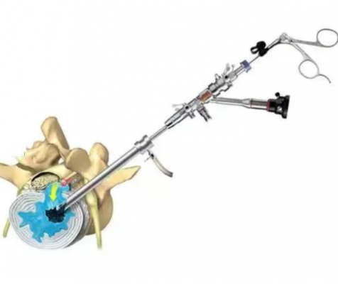 脊柱内窥镜spinal endoscope