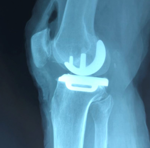 单髁膝关节系统persona partial knee system