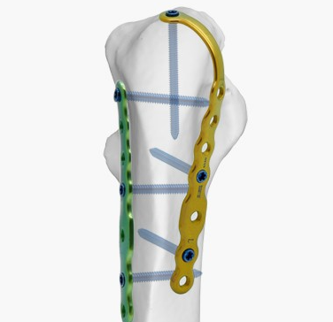 金属锁定接骨板愛派司重建解剖型鎖定骨板系統組