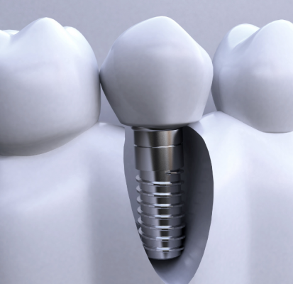 牙科种植体系统dental implant system