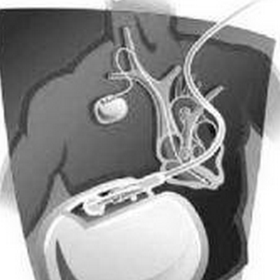 植入式心脏起搏器ld300s