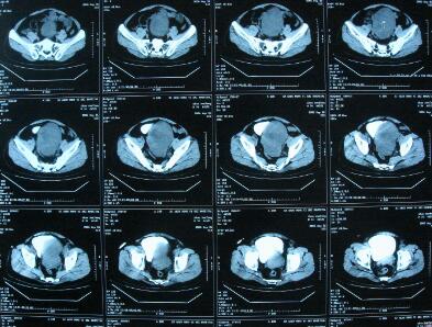 医用干式胶片干式喷墨蓝片