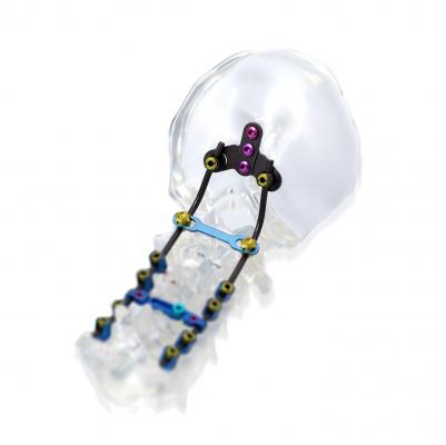 脊柱后路内固定系统