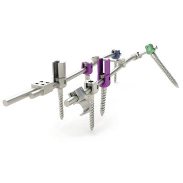 脊柱复位内固定系统