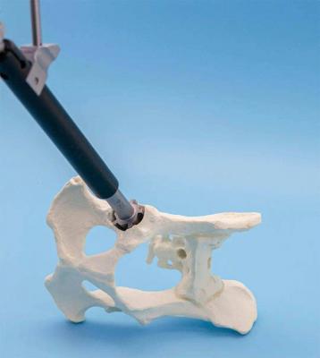 生物型髋臼系统