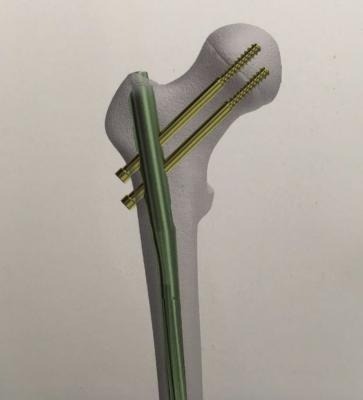 金属带锁髓内钉系统