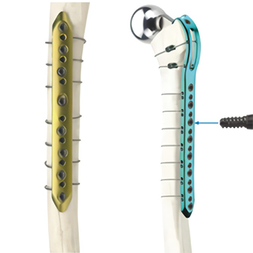 金属缆索内固定系统