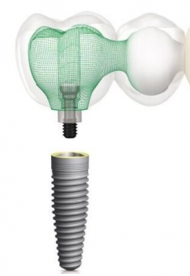 牙种植体系统科惠