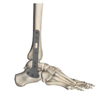 奥斯迈足踝锁定接骨板系统