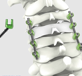 椎板固定板系统威高