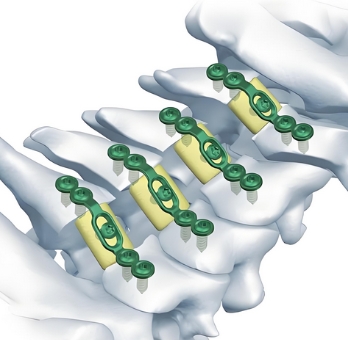 新港椎板固定板系统