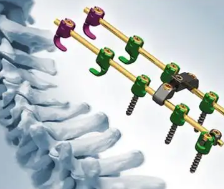 颈椎后路内固定系统沃尔德