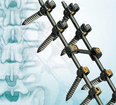 脊柱后路钉棒系统