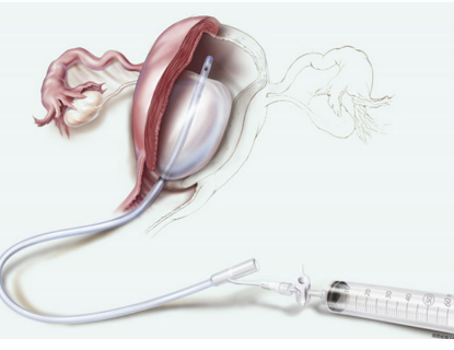 产后止血球囊j-sosr-100500代理