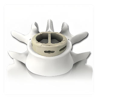 椎间融合器 供应商