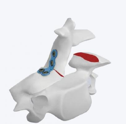 椎板固定板系统代理